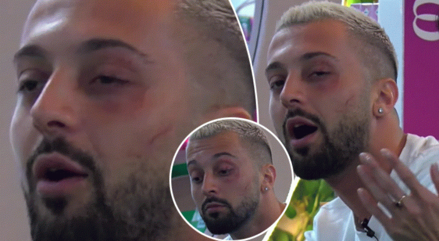 Dhu*na brutale ndaj Gjestit që iu shkaktua në 'Big Brother VIP Albania' është e parecedent