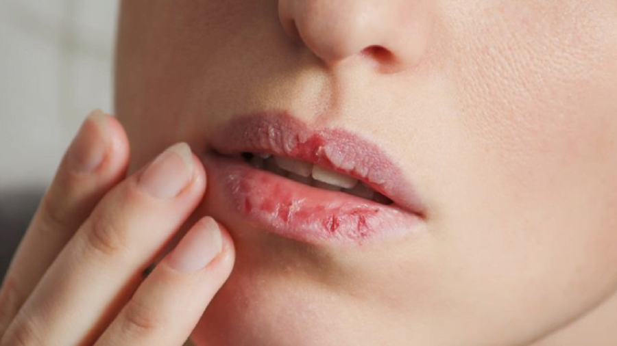 Arsyet pse i keni buzët e plasaritura